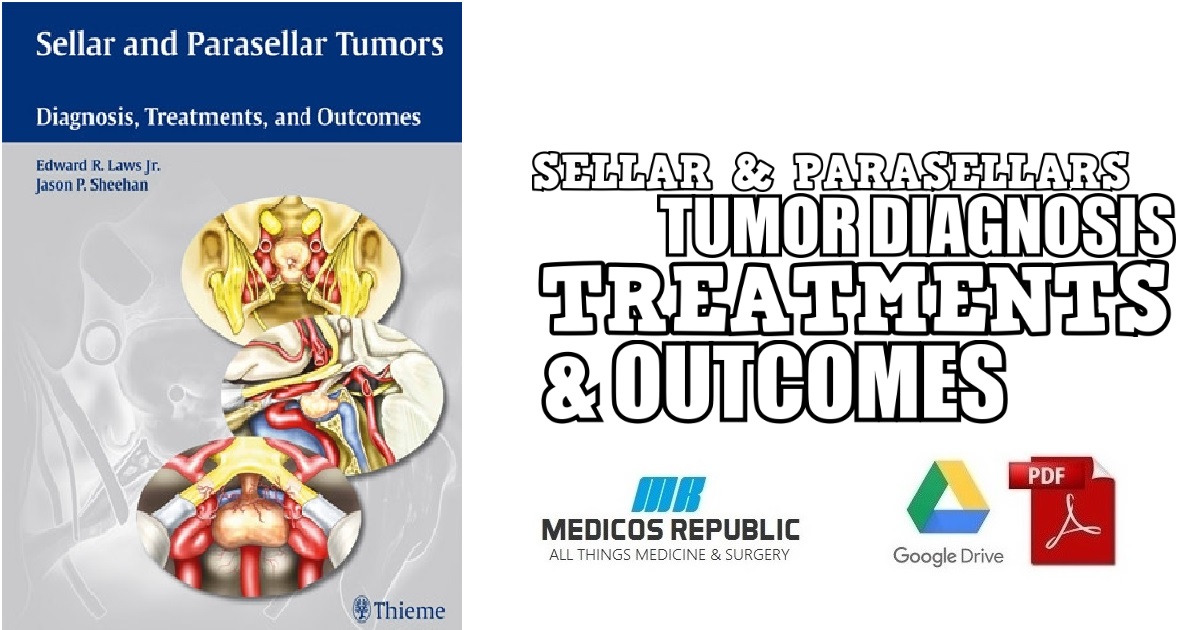 Sellar and Parasellar Tumors Diagnosis, Treatments, and Outcomes PDF