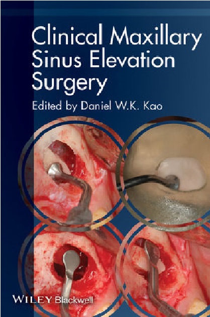 clinical maxillary sinus elevation surgery PDF