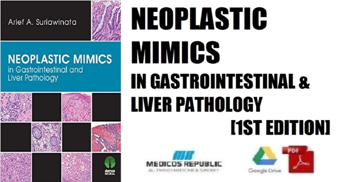 Neoplastic Mimics in Gastrointestinal and Liver Pathology 1st Edition PDF