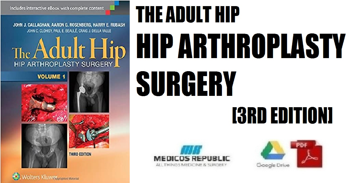 The Adult Hip (Two Volume Set): Hip Arthroplasty Surgery 3rd Edition PDF