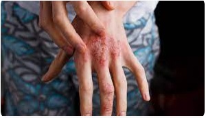 Atopic Dermatitis