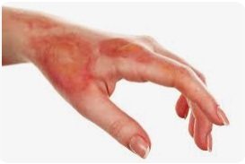 Burn injuries