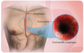 Eosinophilic Esophagitis