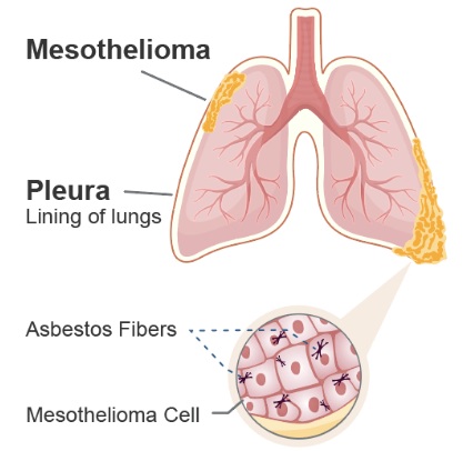 Mesothelioma