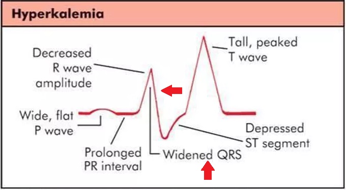 Broadening of the QRS complex