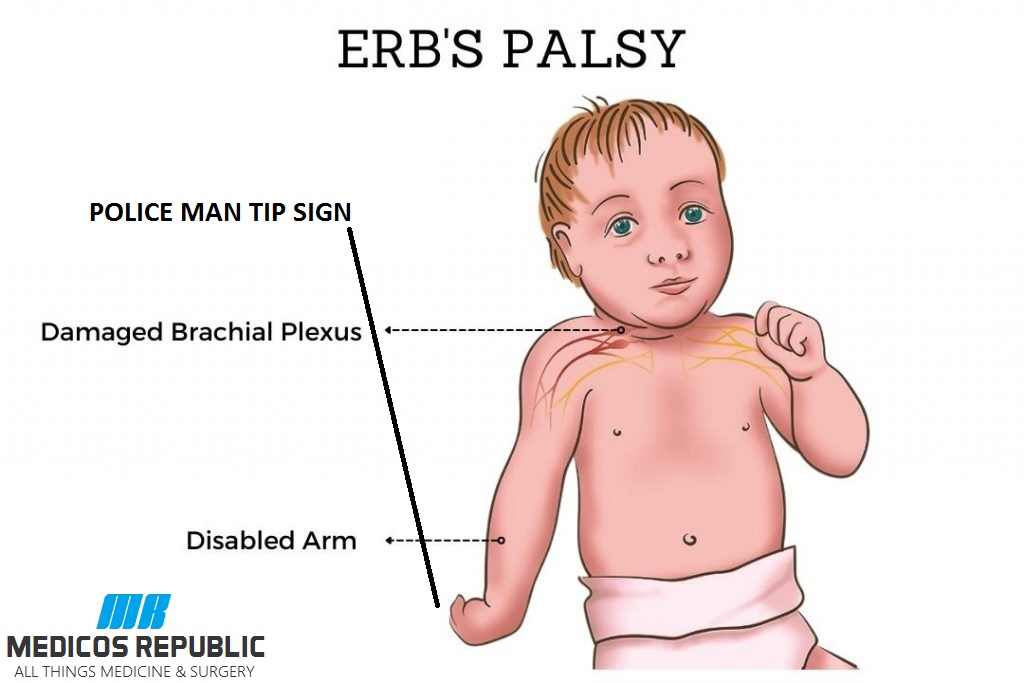 Erb-duchenne palsy