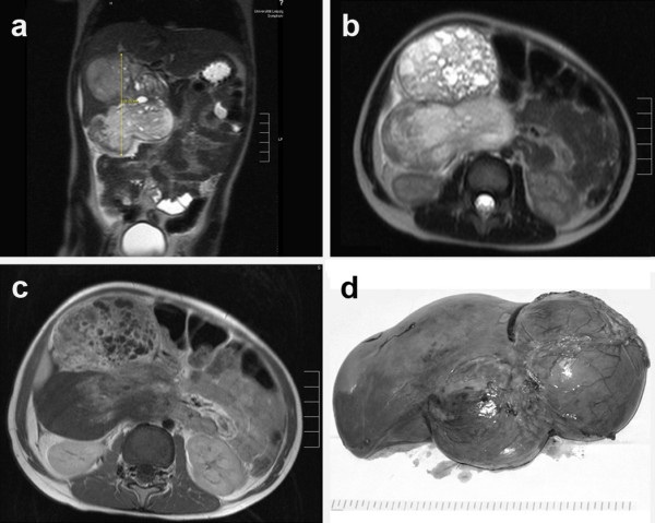 Fetal abdominal mass