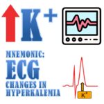 Hyperkalemia ECG Changes Mnemonic