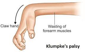 Klumpke's Palsy