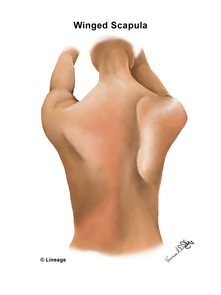 Long Thoracic Nerve Palsy