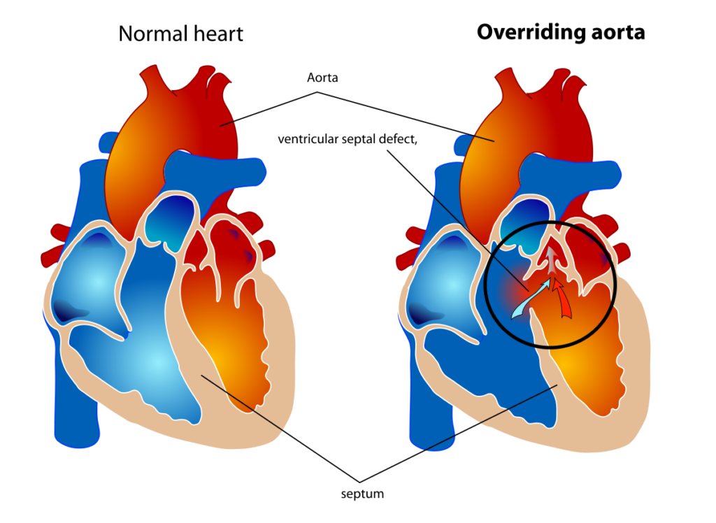 Overriding aorta (OA)