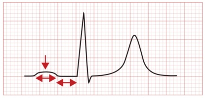 Prolongation of the PR interval