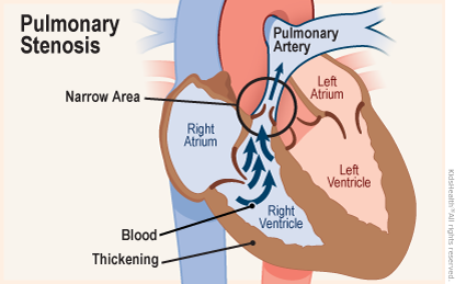 Pulmonary stenosis (PS)