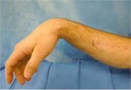 Radial Nerve Lesion