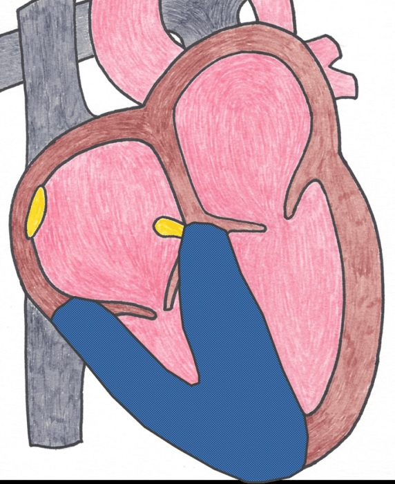 Right ventricular hypertrophy (RVH)
