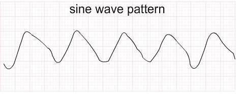 Sine-Wave Pattern