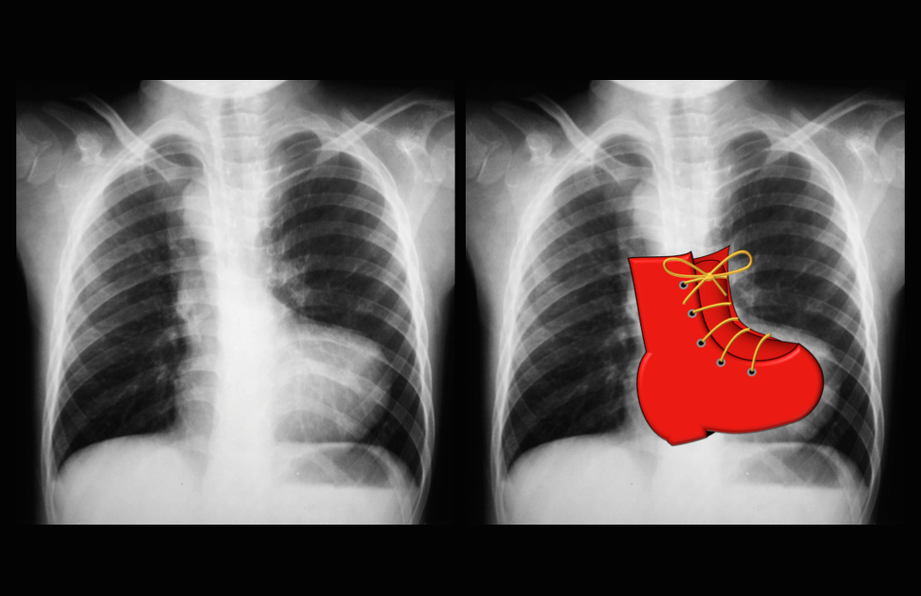 Tetralogy of Fallot CXR (Boot-shaped heart)