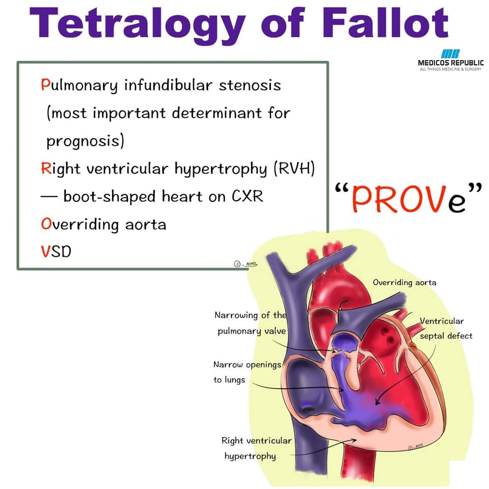 Tetralogy of Fallot PROVe Mnemonic