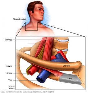 Thoracic Outlet Syndrome