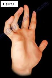 Ulnar Nerve Lesion (Ulnar Claw Hand)