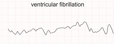 Ventricular Fibrillation