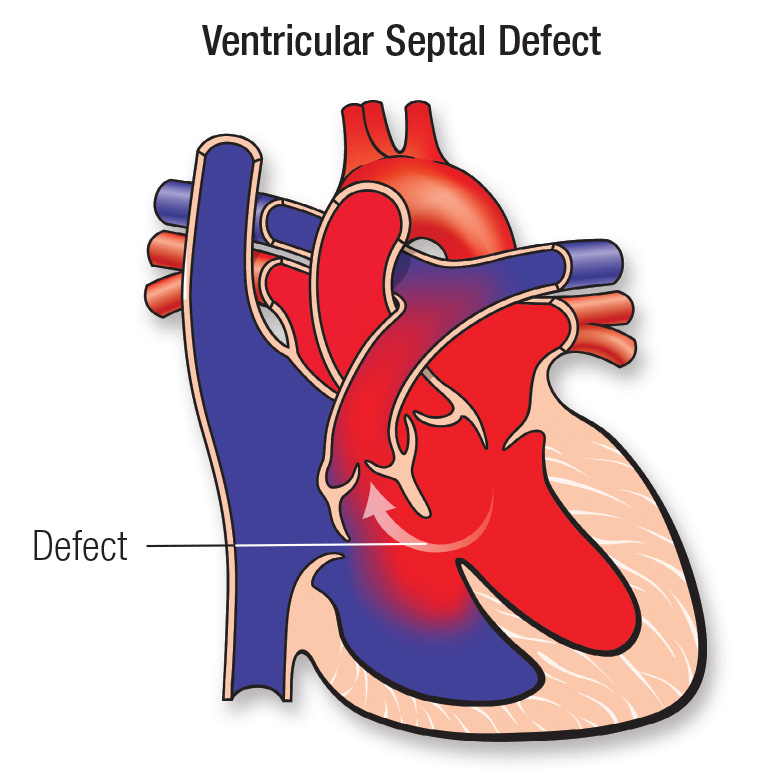 Ventricular septal defect (vsd)