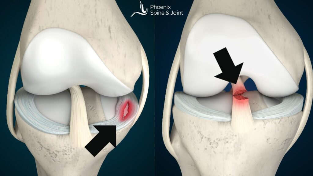 ACL Tear and Meniscus Injury