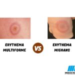 Erythema Multiforme vs Erythema Migrans