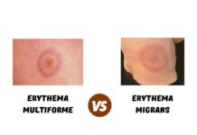 Erythema Multiforme vs Erythema Migrans