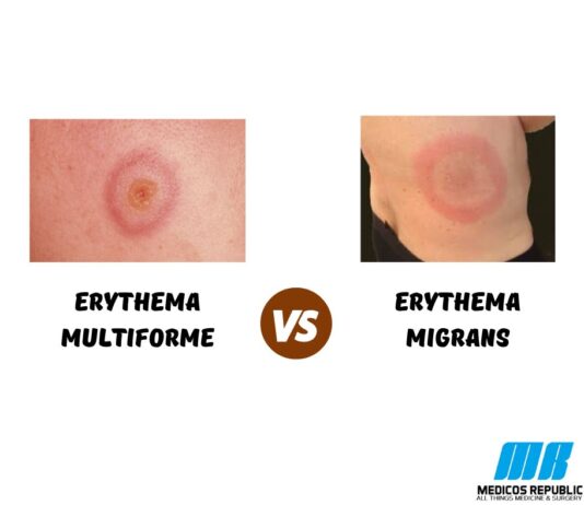 Erythema Multiforme vs Erythema Migrans