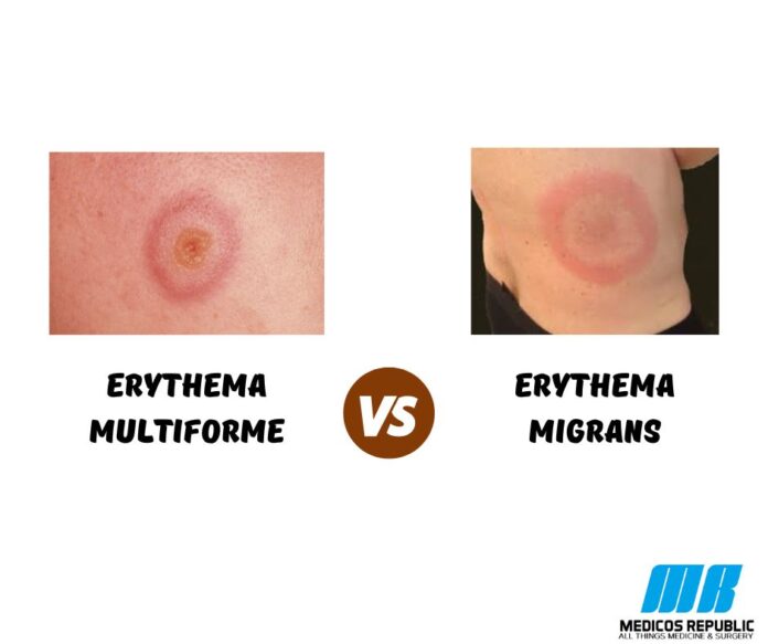 Erythema Multiforme vs Erythema Migrans
