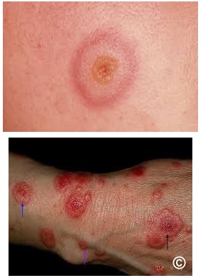 Erythema multiforme