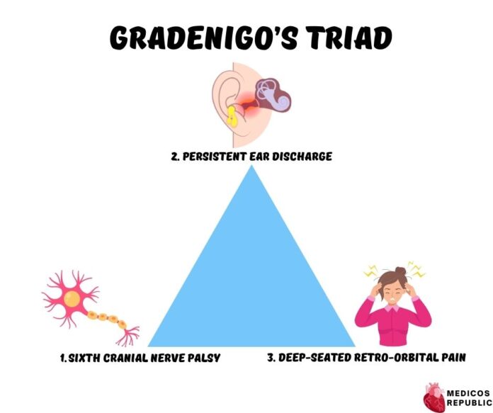 Gradenigo’s Triad for Gradenigo’s Syndrome [Pictorial & High-yield]
