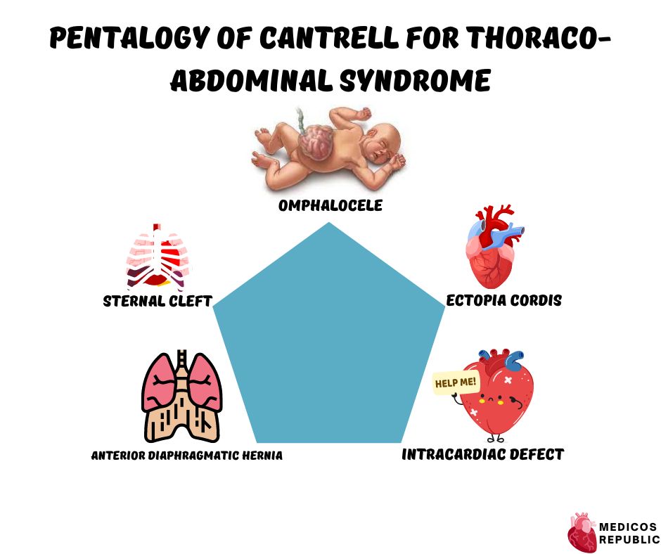 Pentalogy of Cantrell for Thoraco-abdominal Syndrome