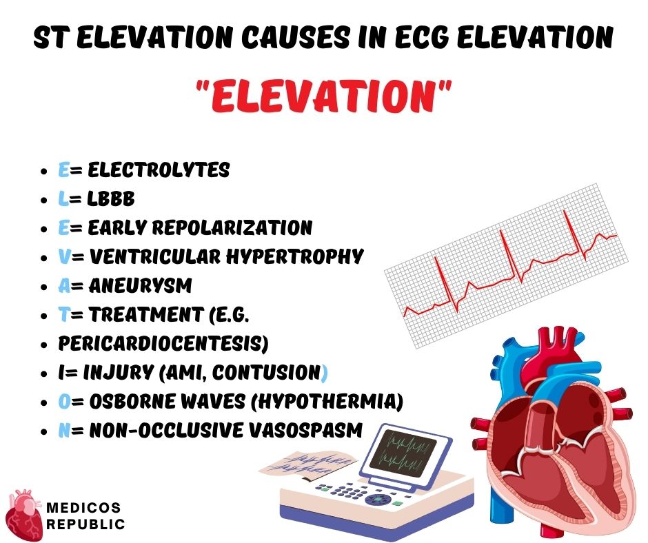 ST Elevation Causes in ECG Elevation