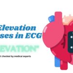 ST Elevation Causes in ECG Mnemonic