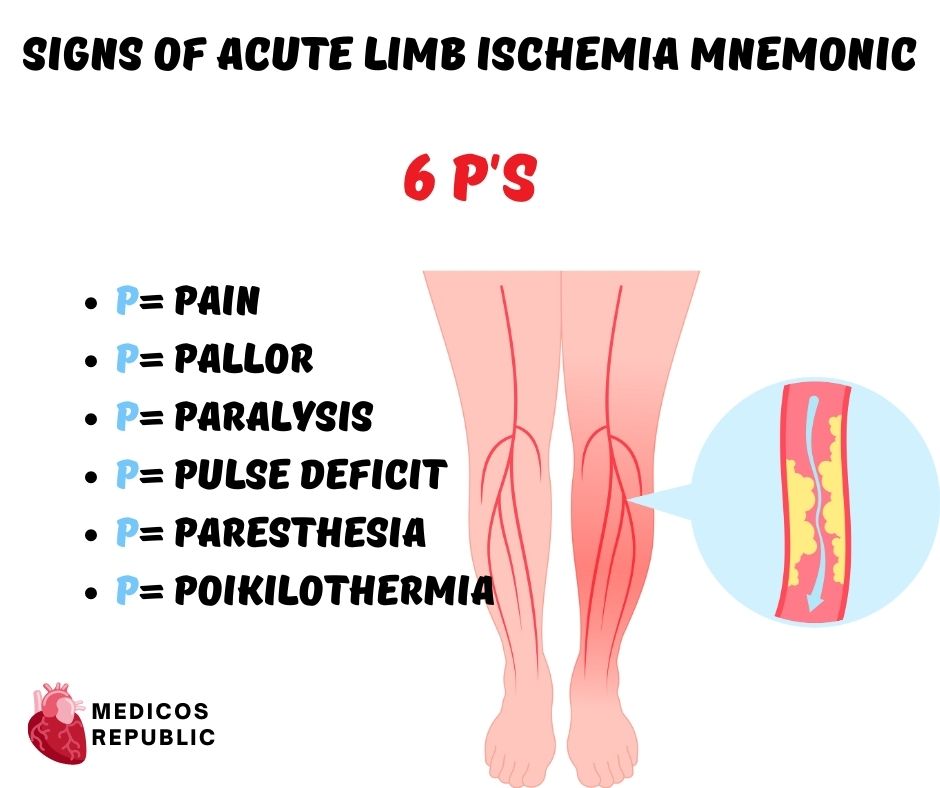 Acute Limb Ischemia Mnemonic