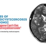 Stages of Neurocysticercosis Mnemonic