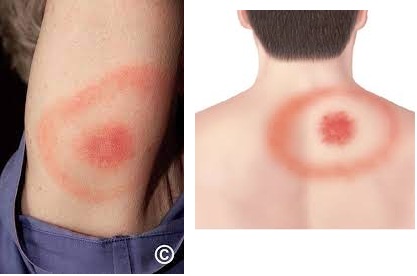 erythema migrans