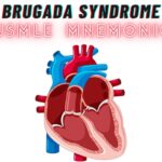 Brugada Syndrome Mnemonic