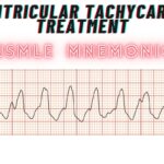 Ventricular Tachycardia Treatment Mnemonic
