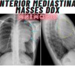Anterior Mediastinal Masses DDx Mnemonic
