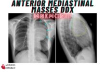 Anterior Mediastinal Masses DDx Mnemonic