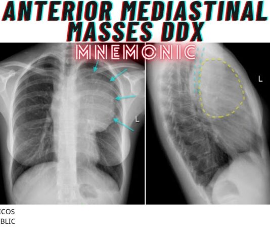 Anterior Mediastinal Masses DDx Mnemonic – “4 T’s’ Anterior Mediastinal Masses DDx Mnemonic
