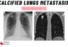 Calcified Lungs Metastasis Differentials Mnemonic