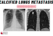 Calcified Lungs Metastasis Differentials Mnemonic