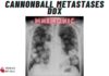 Cannonball Metastases DDx Mnemonic