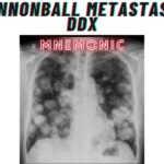 Cannonball Metastases DDx Mnemonic