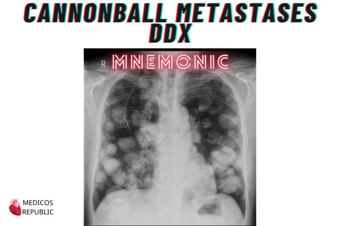 Cannonball Metastases DDx Mnemonic