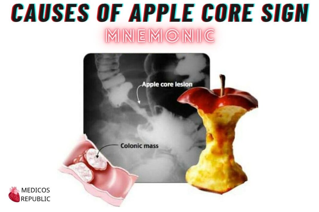 Apple Core Sign Causes Mnemonic: 